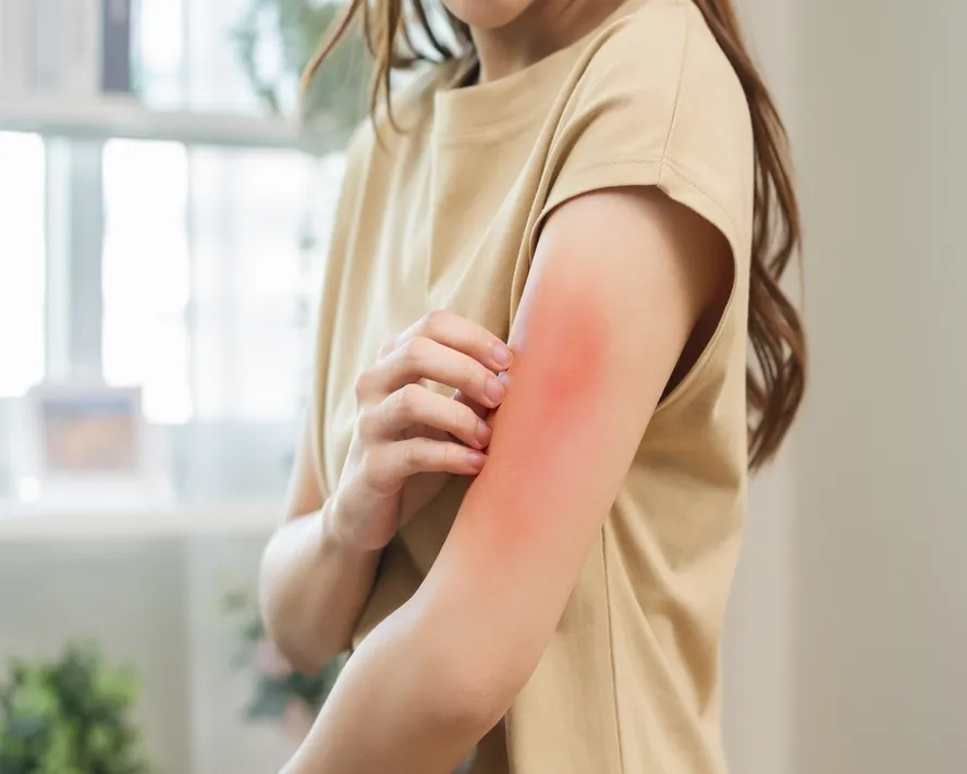 Alerji Kaşıntısı Nasıl Geçer?