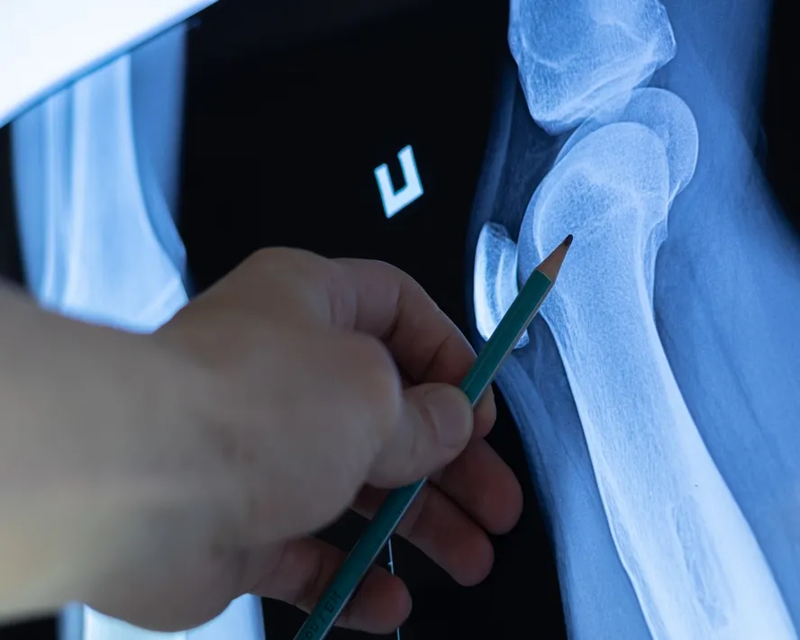 Kemik Tümörü Nedir? Kemik Tümörü Belirtileri