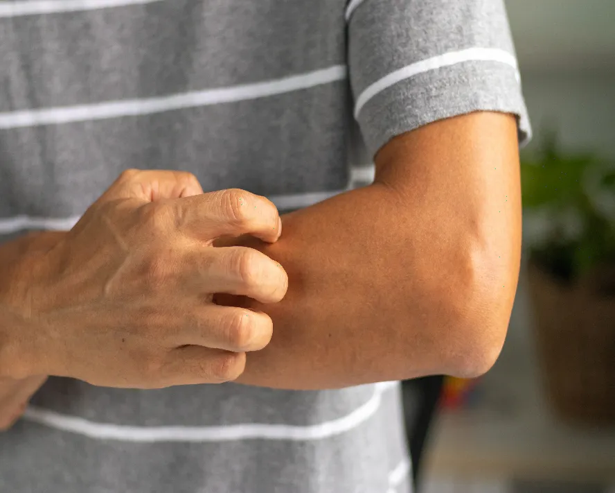 Sinirsel Kaşıntı Nedir? Sinirsel Kaşıntı Belirtileri ve Tedavisi